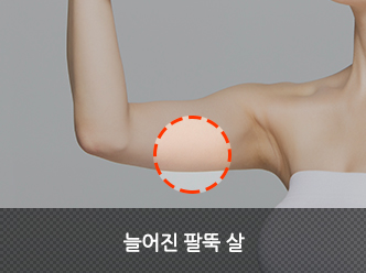 늘어진 팔뚝 살