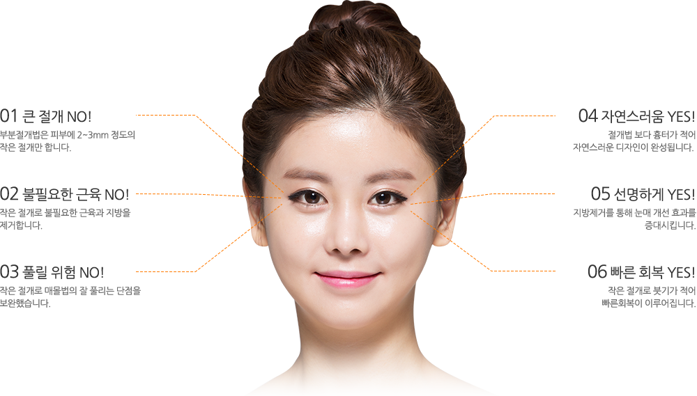 01 큰 절개 NO!부분절개법은 피부에 2~3mm 정도의
작은 절개만 합니다.02 불필요한 근육 NO!작은 절개로 불필요한 근육과 지방을
제거합니다. 03 풀릴 위험 NO! 작은 절개로 매몰법의 잘 풀리는 단점을
보완했습니다. 04 자연스러움 YES! 절개법 보다 흉터가 적어
자연스러운 디자인이 완성됩니다. 05 선명하게 YES! 지방제거를 통해 눈매 개선 효과를
증대시킵니다. 06 빠른 회복 YES! 작은 절개로 붓기가 적어
빠른회복이 이루어집니다.