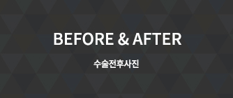 BEFORE&AFTER 수술전후사진