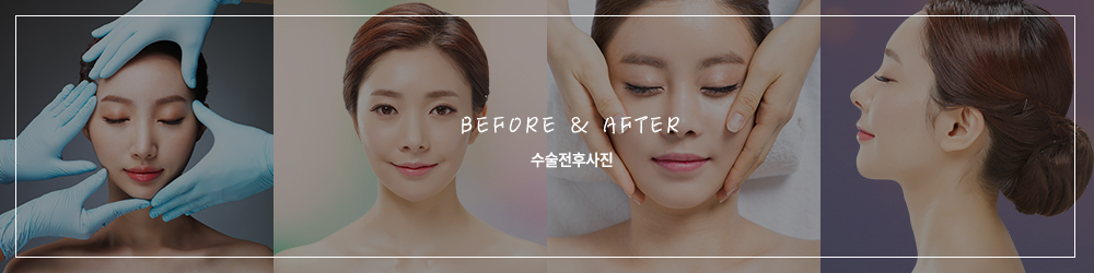 수술전후사진