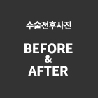 수술전후사진