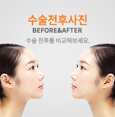 수술전후사진