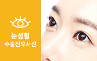 눈성형