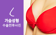 가슴성형