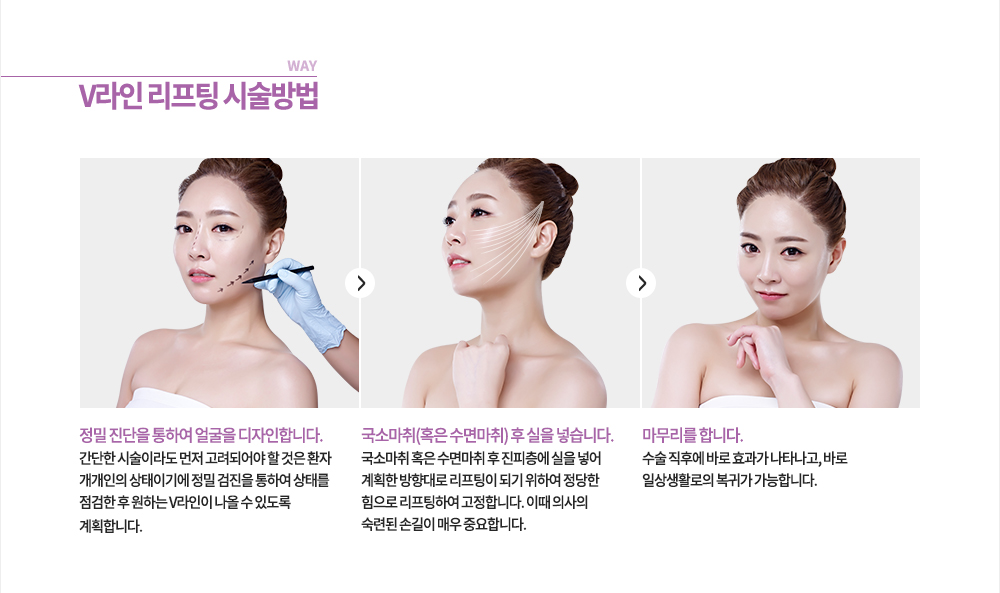 방법
1. 정밀 진단을 통하여 얼굴을 디자인합니다.
-간단한 시술이라도 먼저 고려되어야 할 것은 환자 개개인의 상태이기에 정밀 검진을 통하여 상태를 점검한 후 원하는 V라인이 나올 수 있도록 계획합니다.
2. 국소마취를 합니다. 
-때에 따라 수면 마취도 처방합니다.
3. 실을 넣습니다.
-진피층에 실을 넣어 계획한 방향대로 리프팅이 되기 위하여 정당한 힘으로 리프팅하여 고정합니다. 이때 의사의 숙련된 손길이 매우 중요합니다.
4. 마지막으로 마무리를 합니다.
-수술 직후에 바로 효과가 나타나고, 바로 일상생활로의 복귀가 가능합니다.
