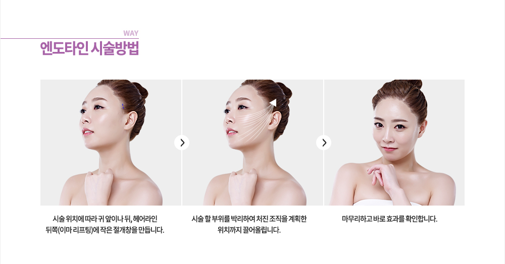 과정
1. 시술 위치에 따라 귀 앞이나 뒤, 헤어라인 뒤쪽(이마 리프팅)에 작은 절개창을 만듭니다.
2. 시술 할 부위를 박리하여 처진 조직을 계획한 위치까지 끌어올립니다.
3. 마무리하고 바로 효과를 확인합니다.
