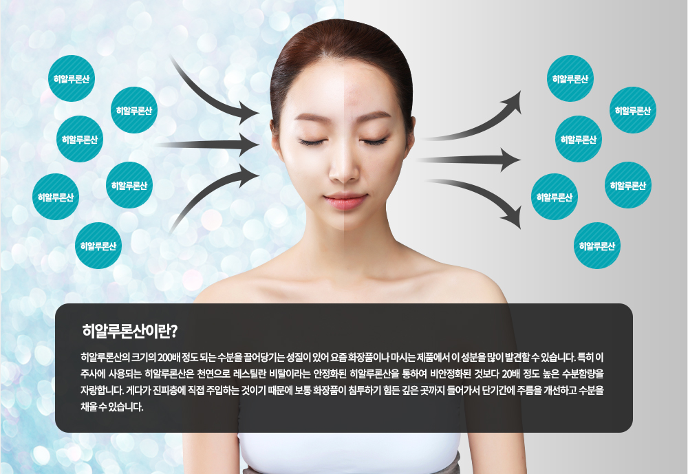 히알루론산이란?
히알루론산의 크기의 200배 정도 되는 수분을 끌어당기는 성질이 있어 요즘 화장품이나 마시는 제품에서 이 성분을 많이 발견할 수 있습니다. 특히 이 주사에 사용되는 히알루론산은 천연으로 레스틸란 비탈이라는 안정화된 히알루론산을 통하여 비안정화된 것보다 20배 정도 높은 수분함량을 자랑합니다. 게다가 진피층에 직접 주입하는 것이기 때문에 보통 화장품이 침투하기 힘든 깊은 곳까지 들어가서 단기간에 주름을 개선하고 수분을 채울 수 있습니다.

