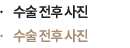 수술전후사진